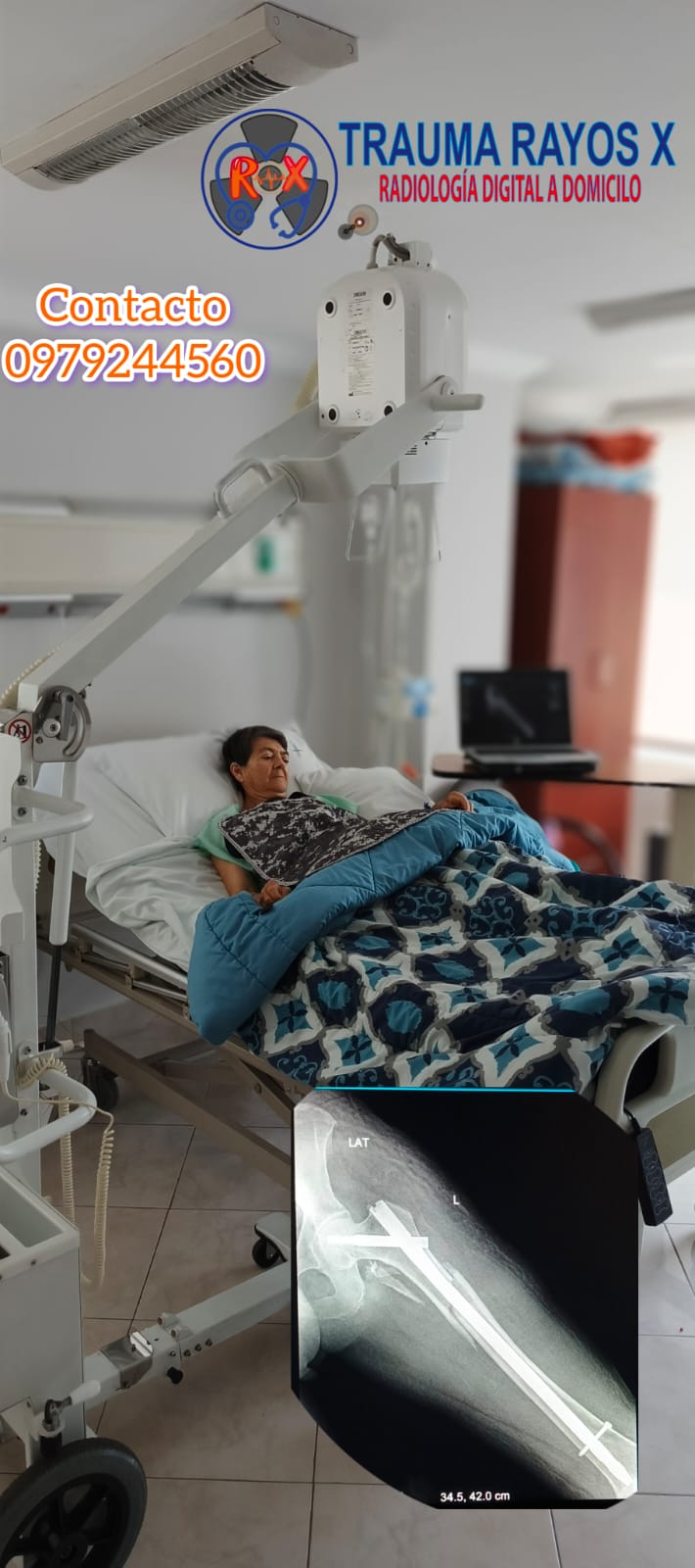 Radiografía de fractura de pierna con placa